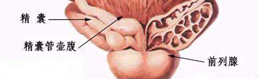 前列腺炎影响精子质